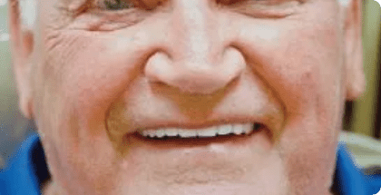 Robert-face-after-1